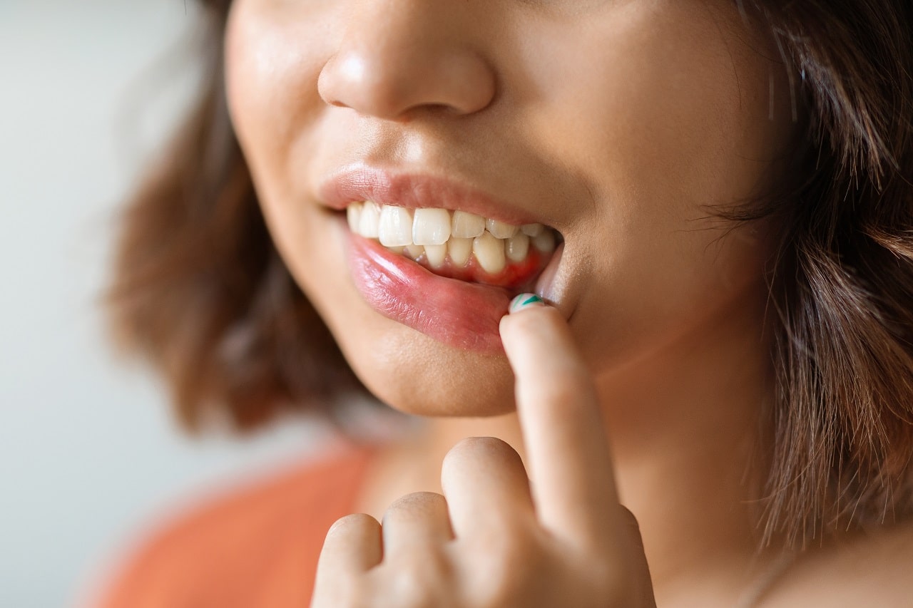 Ways to Prevent And Treat Gum Diseases