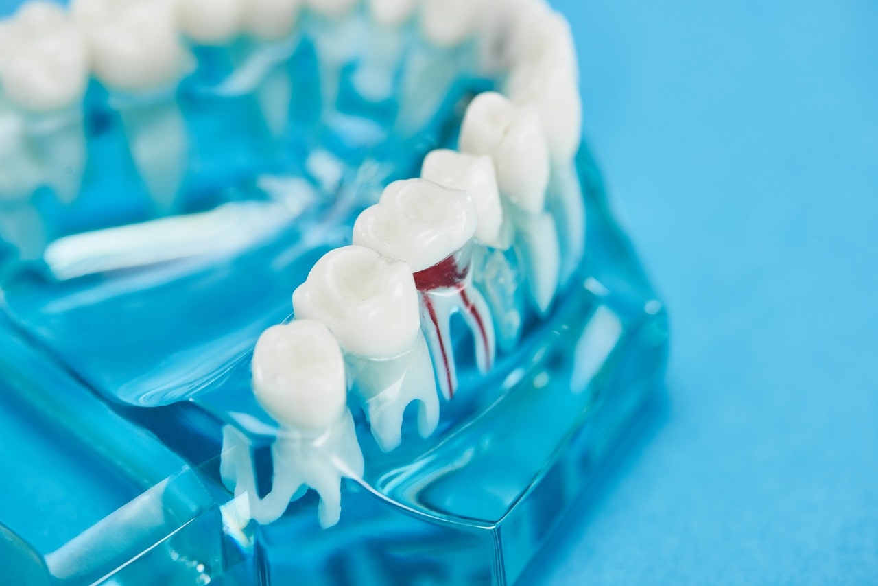 Attention Those Who Will Have Root Canal Treatment!