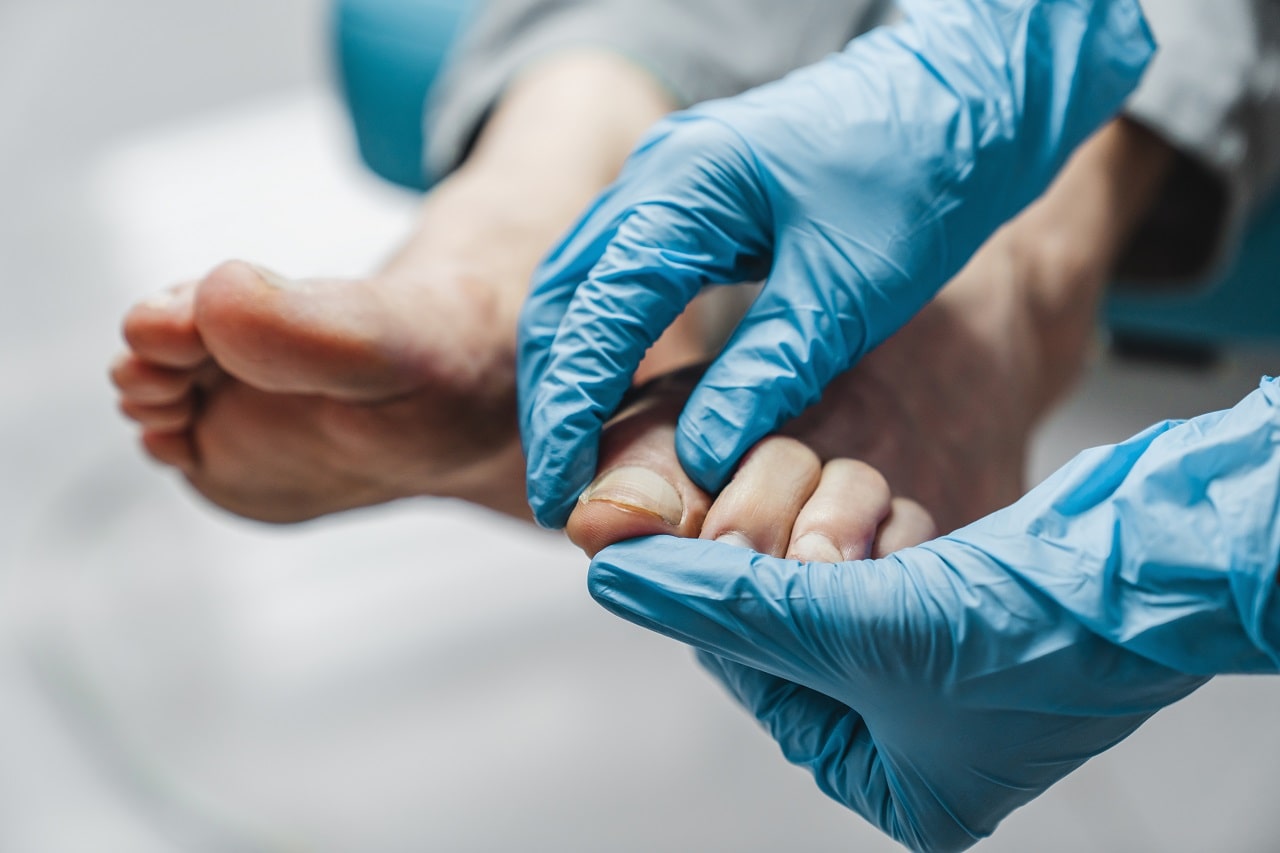 What is Foot Fungus How Is It Treated