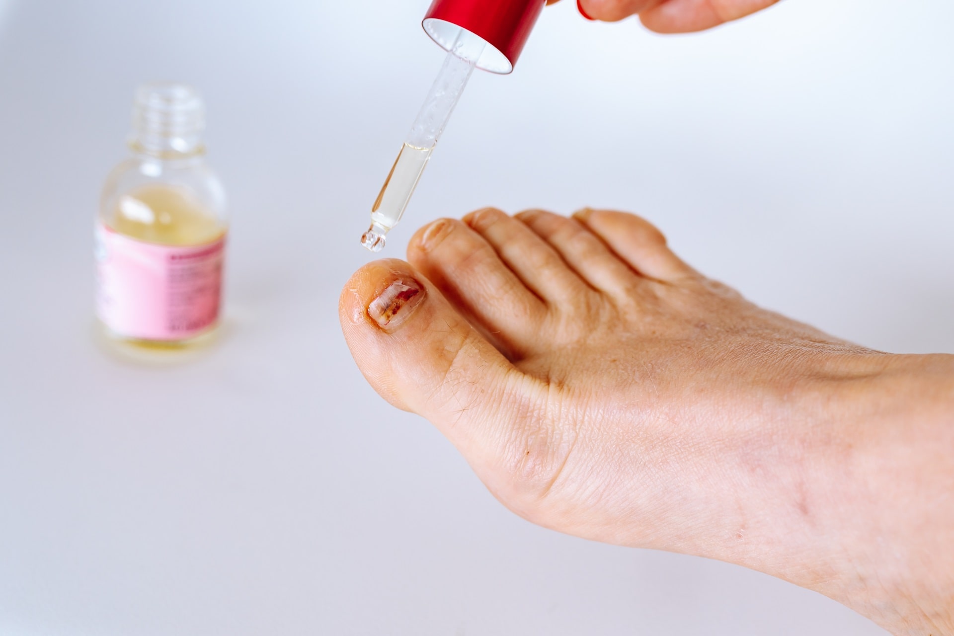 What is nail fungus, why does it happen and how does it go away? 