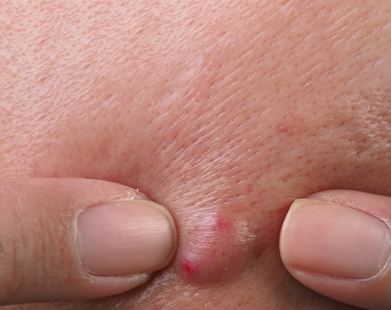 The Facts About Abscesses: Is It Contagious?
