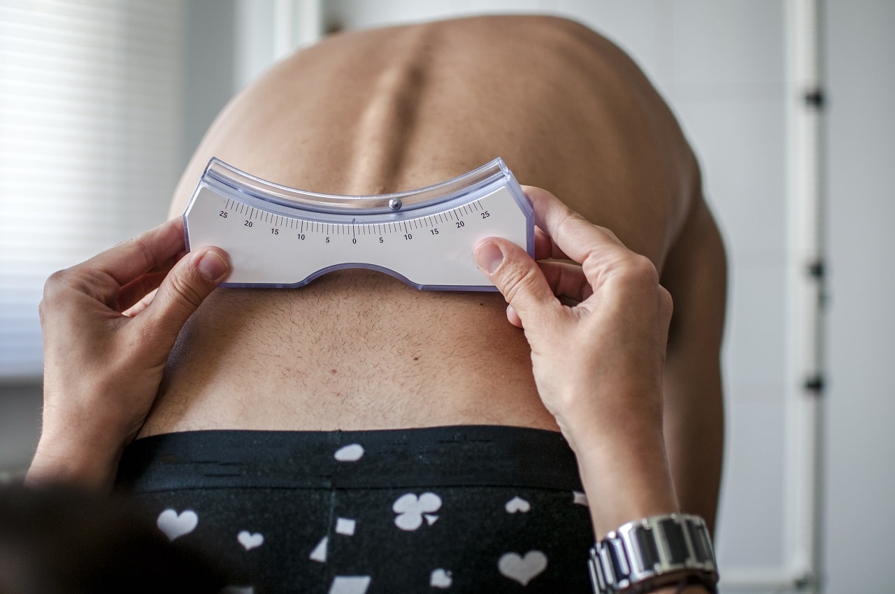What is Scoliosis?
