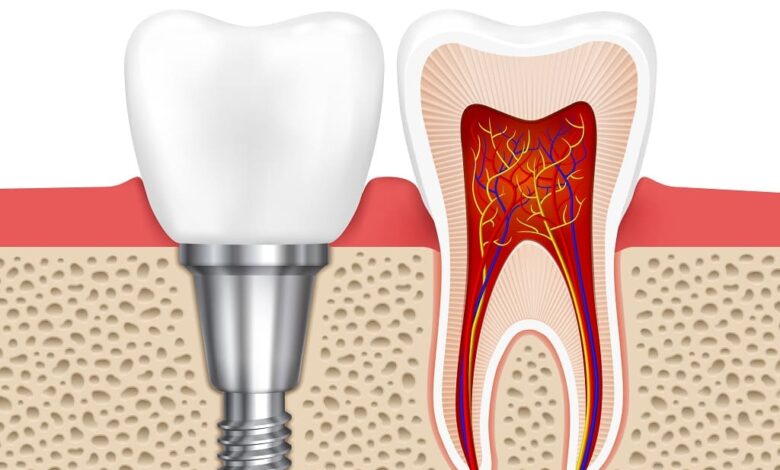 10 Things to Consider After Dental Treatments