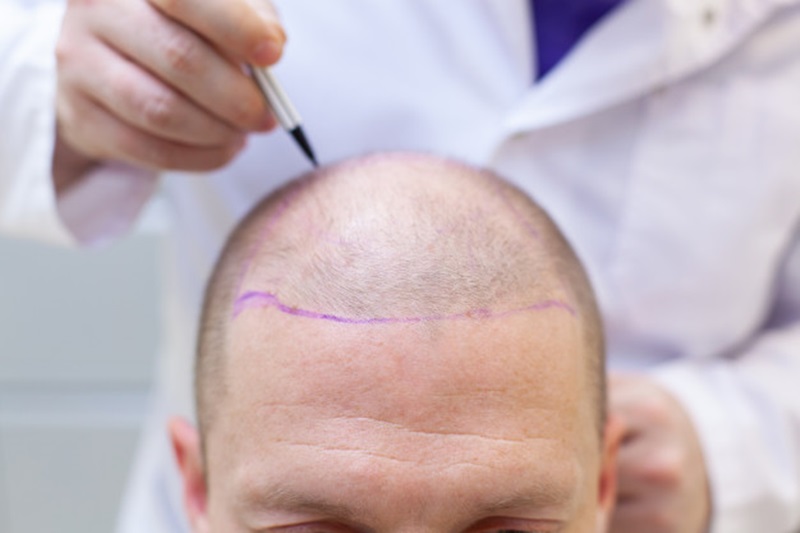 Turkey's Best Hair Transplantation Centers