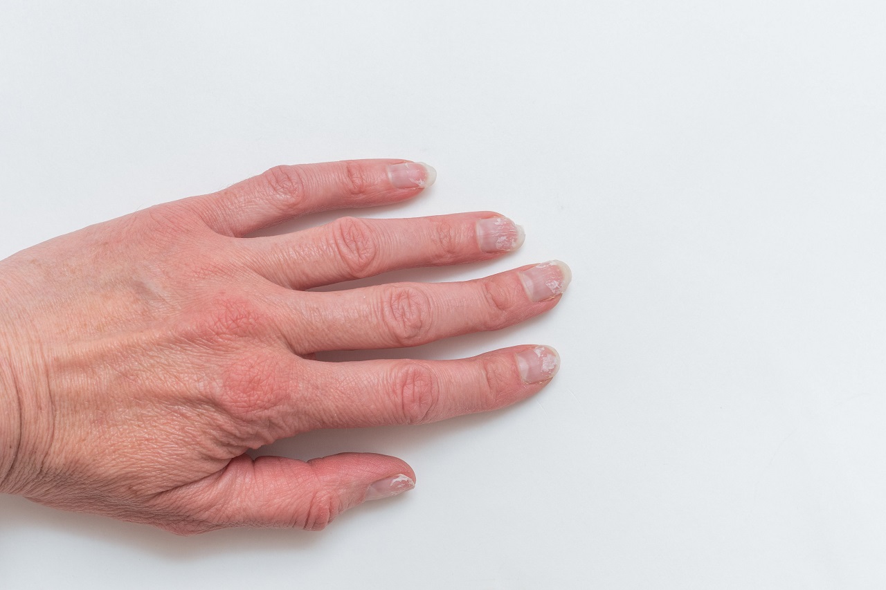 Why do white spots appear on the nails?
