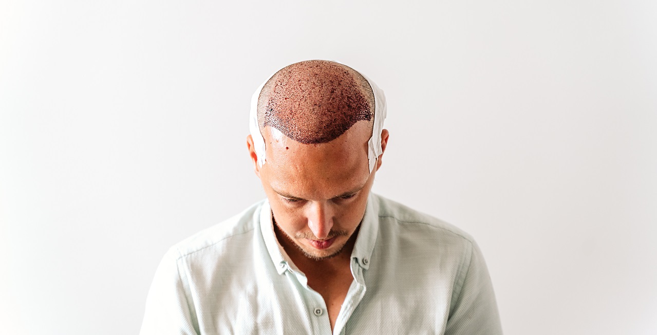 Hair transplant: Hair vacation experience in Turkiye